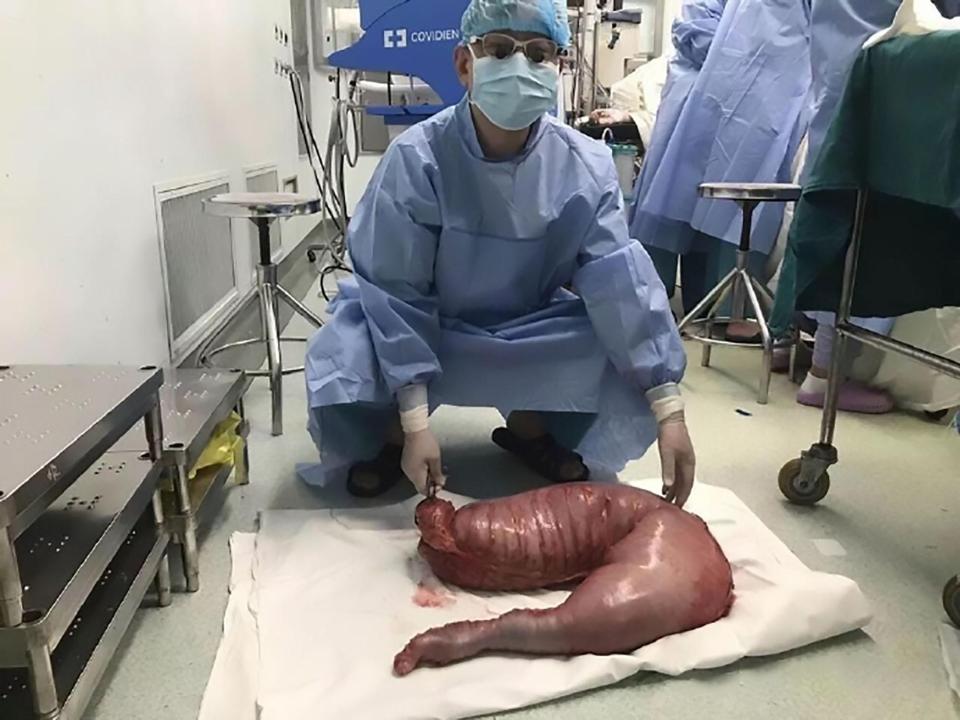 Giải cứu bệnh nhân "bụng to như sắp nổ"