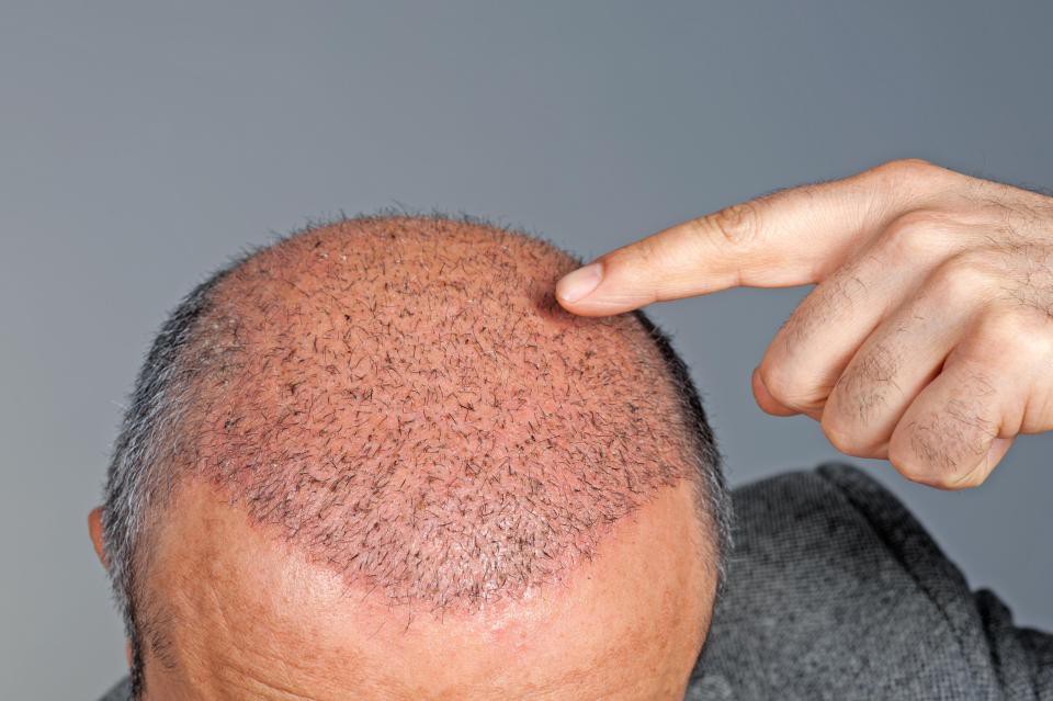 Trị hói đầu: Một công đôi việc!