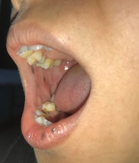 Một phụ nữ Bến Tre mắc bệnh cực kỳ hiếm gặp