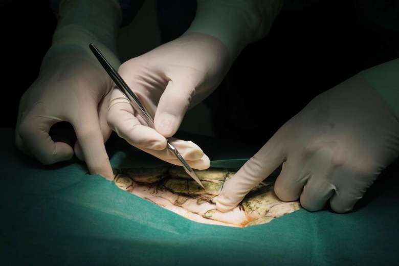Các bác sĩ tiến hành phẫu thuật cho Omsin. Ảnh: Reuters