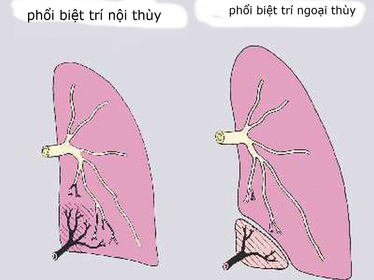 Nội soi th&agrave;nh c&ocirc;ng ca dị tật phổi hiếm gặp - Ảnh 1.