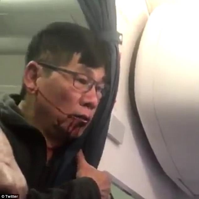 
Sau vụ việc, &ocirc;ng David Dao n&oacute;i rằng &ocirc;ng bị thương khắp th&acirc;n thể. Ảnh: Twitter

