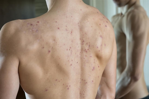 Cách điều trị mụn trứng cá ở lưng vô cùng hiệu quả