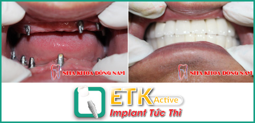 Cấy ghép răng Implant ETK Active ở đâu?