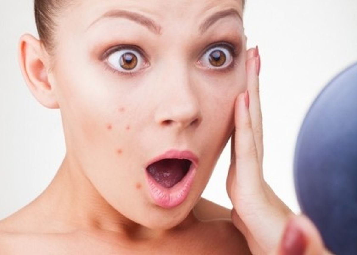 Vị trí mụn trên cơ thể cảnh báo sức khỏe có vấn đề