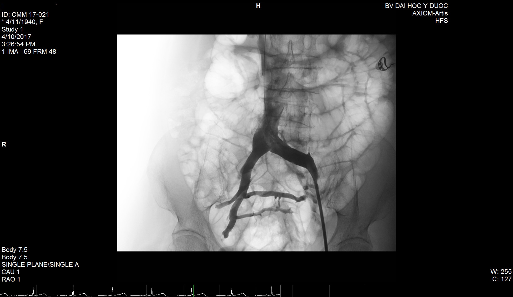 Lần đầu tiên đặt stent trị được suy tĩnh mạch
