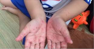 Mùa tựu trường, coi chừng bệnh trẻ em