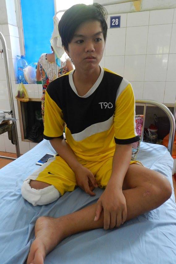 
Tr&uacute;c Giang đ&atilde; bị cắt bỏ 1/3 ch&acirc;n phải
