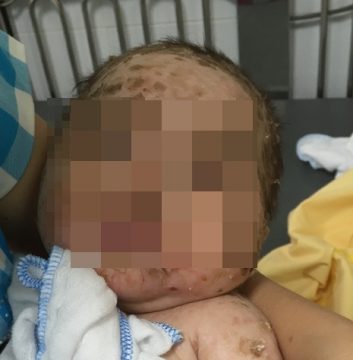 
Bệnh nhi bị lở lo&eacute;t khắp mặt v&agrave; người
