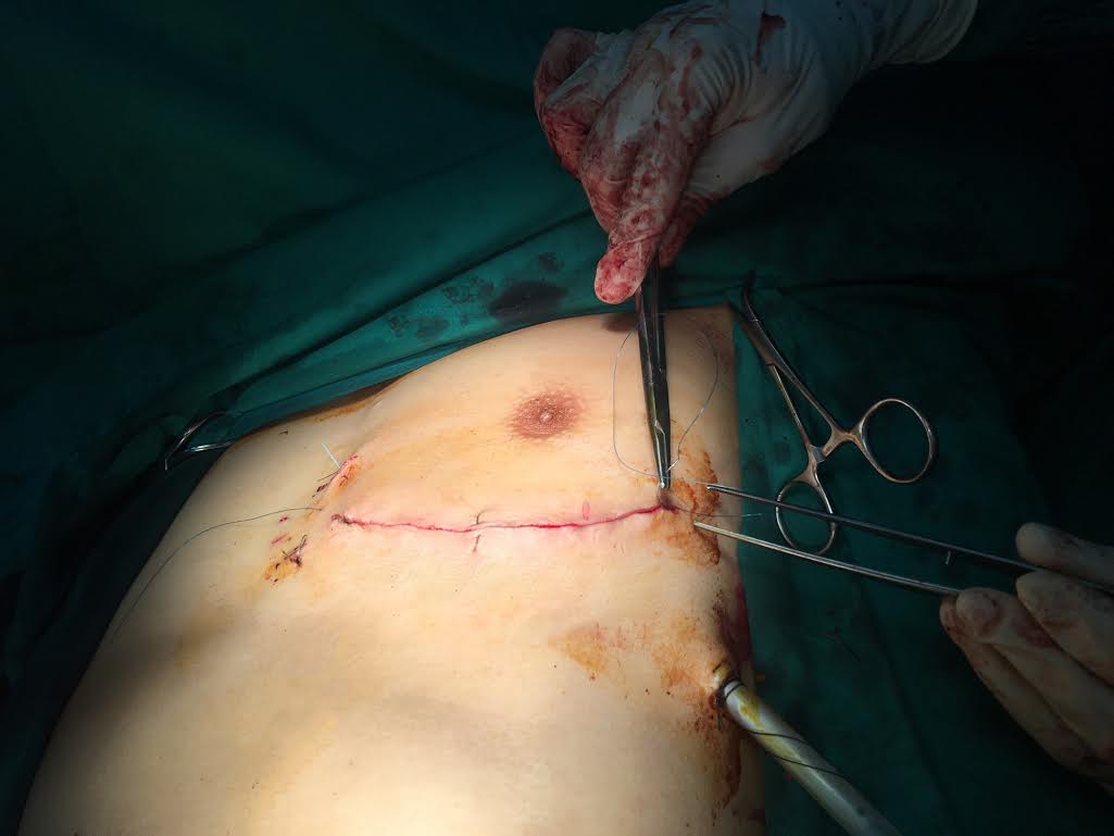 Cứu sống một người tự đâm thủng tim