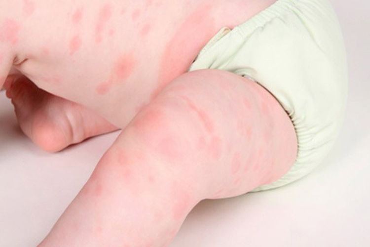 Không hẳn trẻ ngứa là dị ứng!