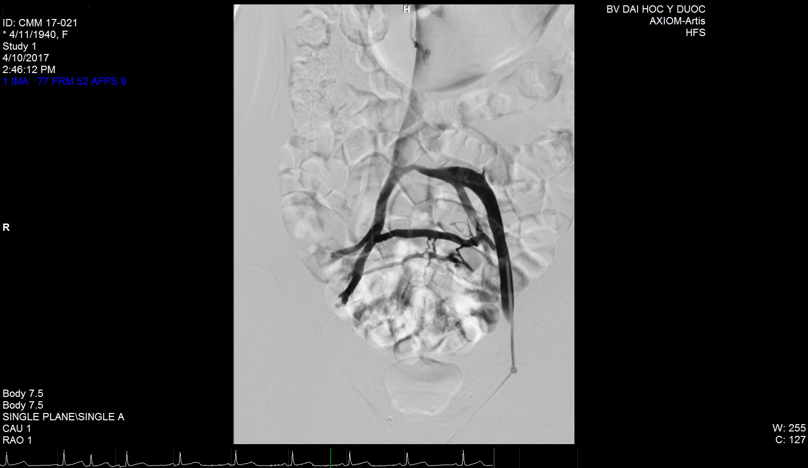 Tĩnh mạch người bệnh bị tắc trứơc khi đặt stent.