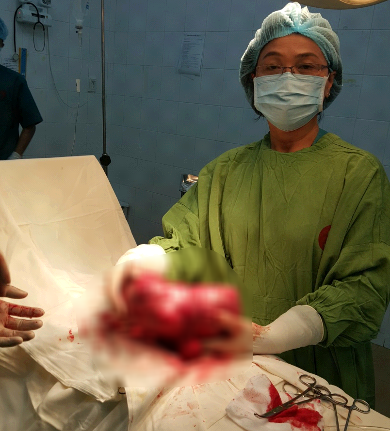 Bụng to như thai 8 tháng, bóc ra u xơ 2,5 kg