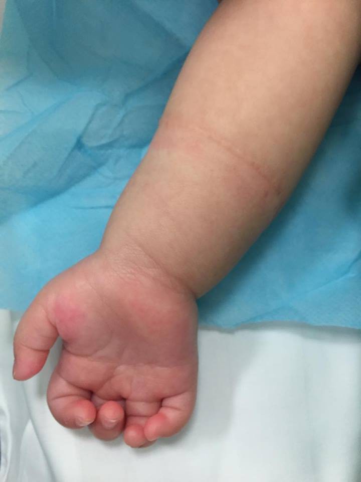 Bé gái bị thắt vòng tay bẩm sinh hiếm gặp - Ảnh 3.