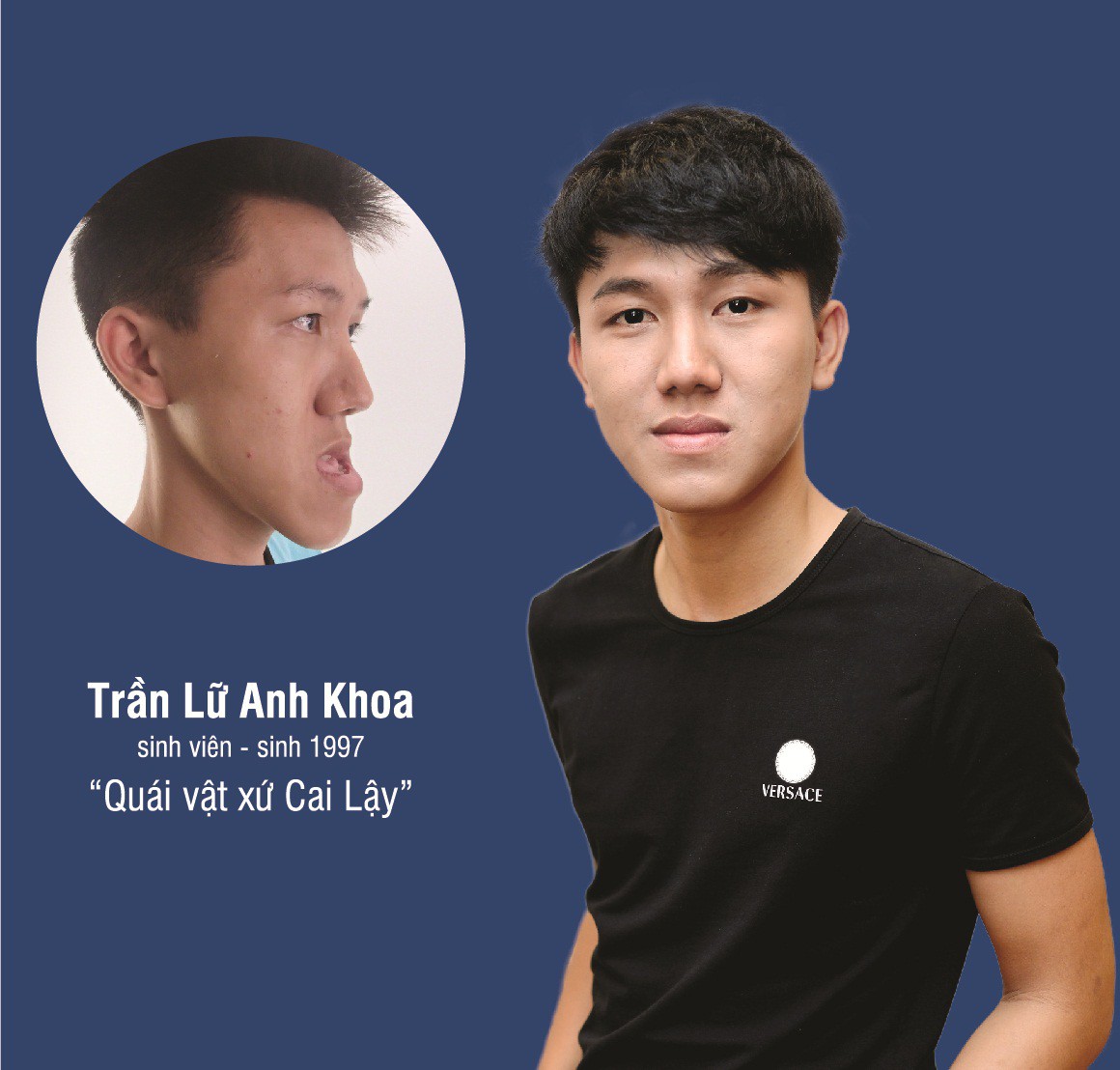 Người bị hô, lệch hàm trên toàn quốc được phẫu thuật miễn phí