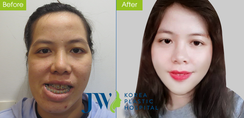 5 giờ cắt hàm cứu cô gái hàng chục năm không ngậm miệng được