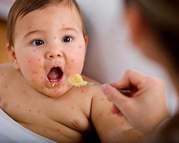 Trẻ bị chân tay miệng nên ăn những món gì tốt cho sức khỏe?