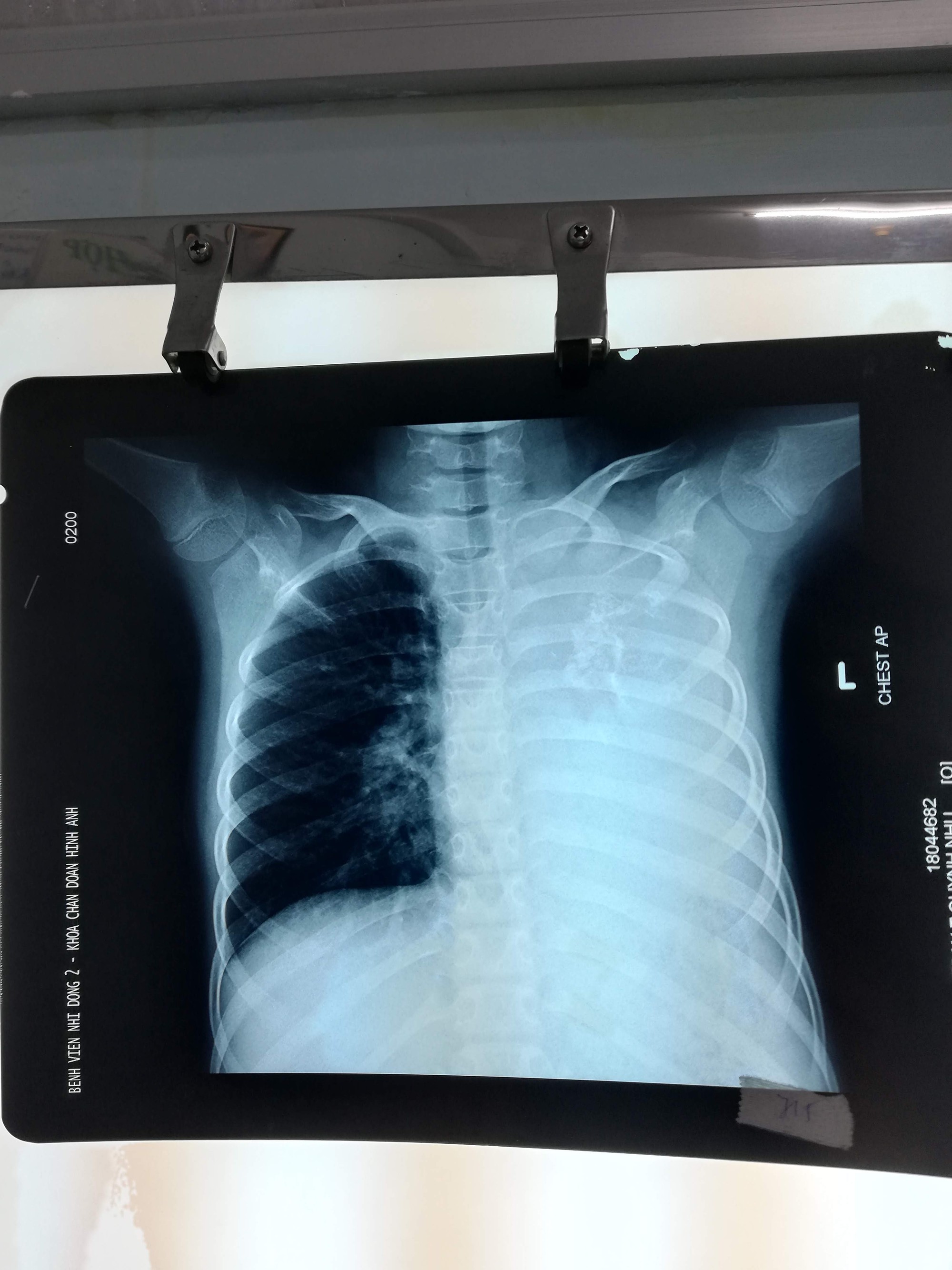 Cứu bé gái có khối u phổi khổng lồ nặng 1,5 kg