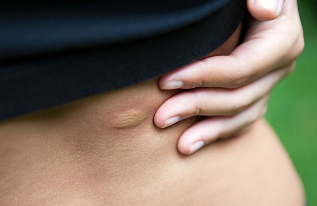 1 con bọ cắn, người đàn ông suýt chết vì bị "ăn thịt" dần