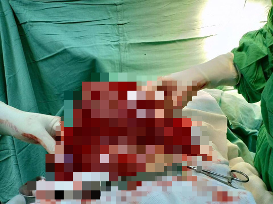 Nghĩ do ngồi nhiều nên bụng to, nào ngờ khối u nặng 4kg đang hành hạ - Ảnh 1.
