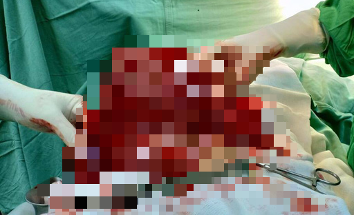 Nghĩ do ngồi nhiều nên bụng to, nào ngờ khối u nặng 4kg đang hành hạ