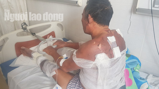 Ch&aacute;y kh&iacute; gas khi chi&ecirc;n kh&ocirc;, vợ v&agrave; chồng tai biến bị bỏng rất nặng - Ảnh 2.