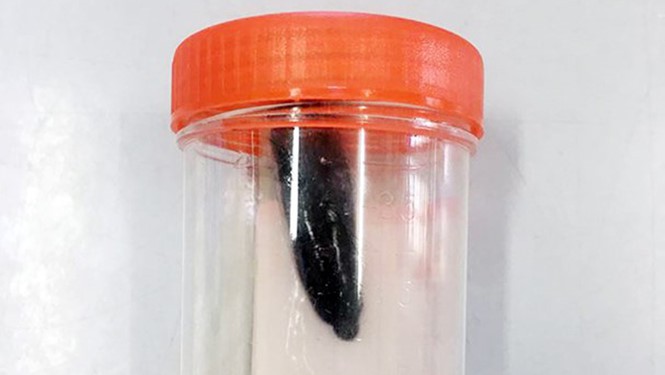 Hãi hùng con đỉa dài 5 cm sống 2 tháng trong cổ bé gái 9 tuổi