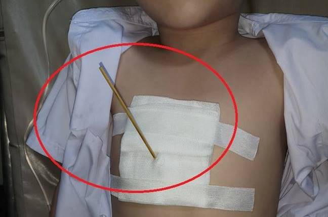 Bé 7 tuổi bị bạn dùng cây xiên cá viên chiên đâm trúng ngực