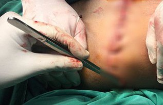 Người đàn ông ở Đồng Nai bị máy cưa cắt ngang bụng