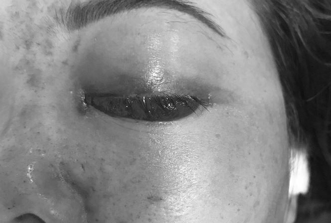Chủ tiệm spa bị phạt tiền vì tiêm filler gây mù mắt