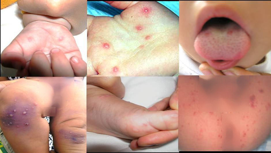 Dịch tay ch&acirc;n miệng, sốt xuất huyết c&ograve;n k&eacute;o d&agrave;i đến th&aacute;ng 11 - Ảnh 2.