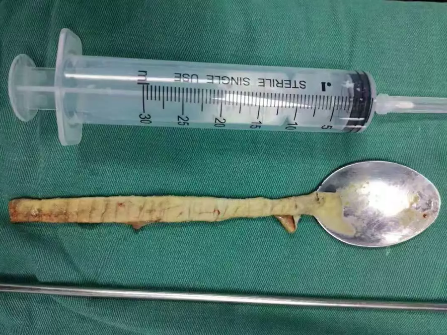 Muỗng d&agrave;i 20 cm kẹt trong cổ họng 1 năm mới đi b&aacute;c sĩ - Ảnh 2.