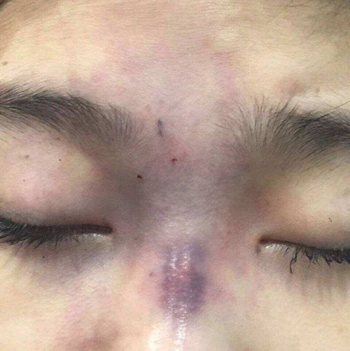 Ôm hận vì tiêm filler giá rẻ