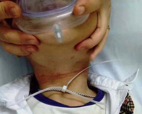 Cô giáo đưa học sinh cấp cứu vì dây nhựa thít cổ