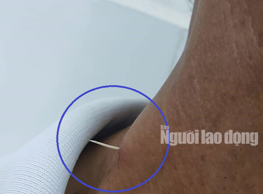 Hãi hùng xương cá đâm xuyên thực quản, lộ ra ngoài da