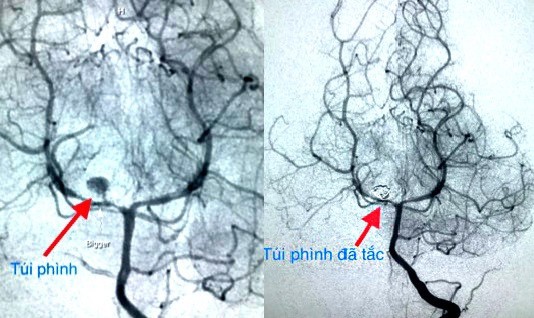 Căn bệnh hiếm gặp cực nguy hiểm ở trẻ nhưng không dễ phát hiện