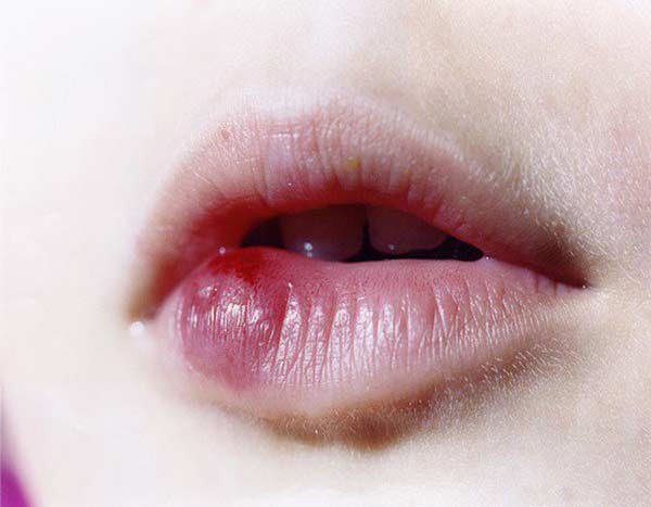 Đua nhau tiêm filler, nhiều chị em môi bỗng cứng đơ - Ảnh 3.