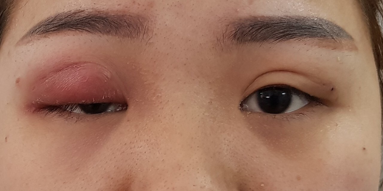 Kim khâu gãy nằm trong mắt lúc nhấn mí