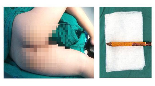 Ớn lạnh hình ảnh bé trai bị bút chì đâm thấu mông đến 8 cm
