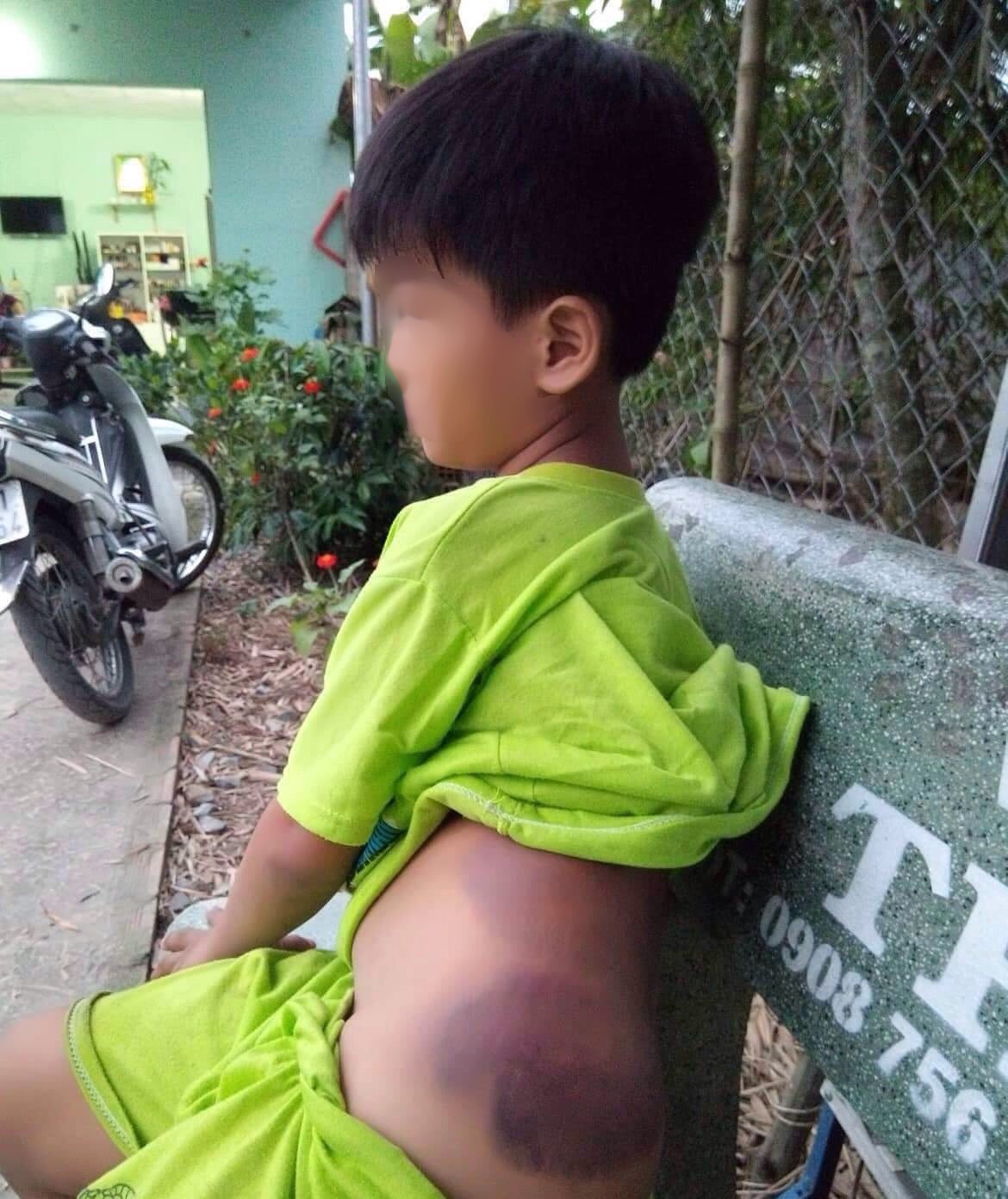 Học sinh tố bị c&ocirc; gi&aacute;o đ&aacute;nh bầm t&iacute;m sườn, m&ocirc;ng - Ảnh 1.