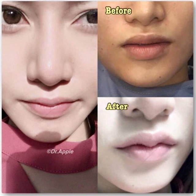 Bất chấp tai biến, nhiều chị em bỏ tiền làm... môi sừng trâu - Ảnh 1.