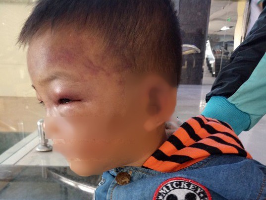 Bé 2 tuổi thâm tím mặt, nhập viện nghi bị bố dượng bạo hành