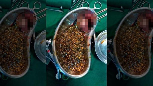 Hy hữu: Bác sĩ gắp 2.350 viên sỏi mật trong cơ thể 1 phụ nữ - Ảnh 2.