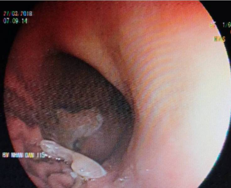 Đang ăn phở, bị dị vật chắn ngang cổ họng