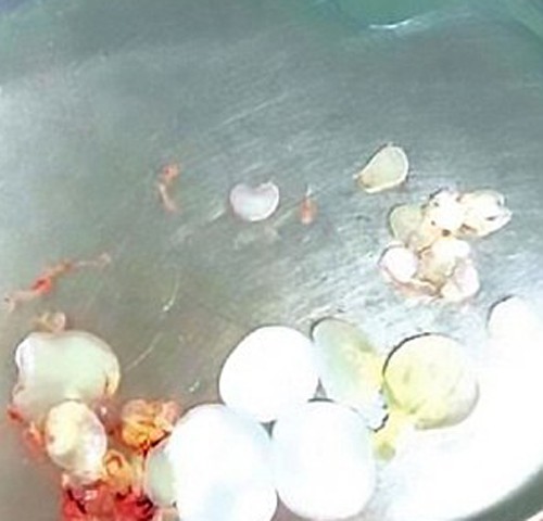  Ăn thịt sống, ngươi đ&agrave;n &ocirc;ng d&iacute;nh 30 trứng s&aacute;n d&acirc;y trong n&atilde;o - Ảnh 1.