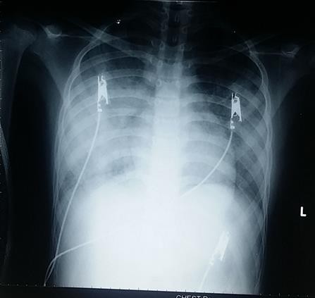Hội chẩn nước ngo&agrave;i chữa ca bệnh 9 năm ho ra m&aacute;u - Ảnh 2.