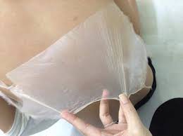 Bác sĩ da liễu lý giải nguy cơ ung thư da do tắm trắng