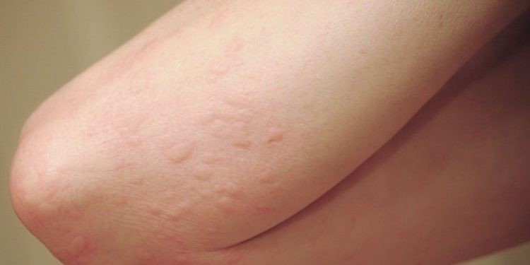 Dị ứng thức ăn có thể gây tử vong?