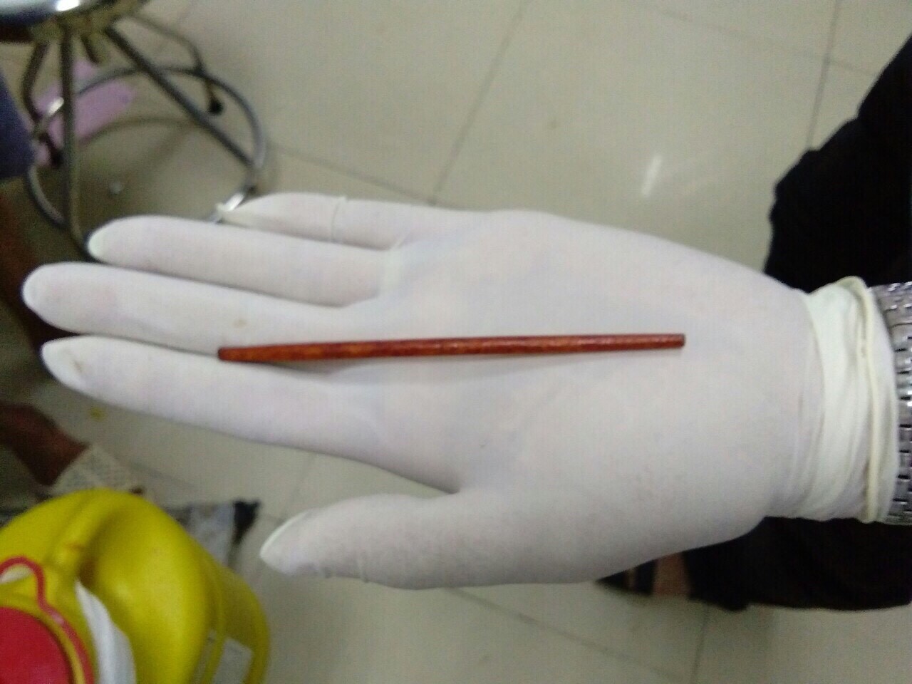 Nhậu say bí tỉ, tỉnh dậy thấy đũa 12 cm chui vào dương vật - Ảnh 2.