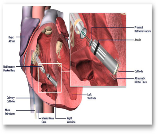 Cứu sống bệnh nhân nhờ đặt máy tạo nhịp tim không dây vào tim